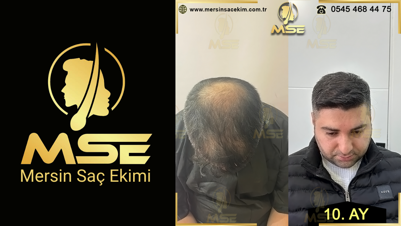 MERSİN SAÇ EKİMİ